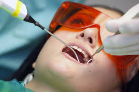 lấy cao răng để bảo vệ sức khỏe răng miệng