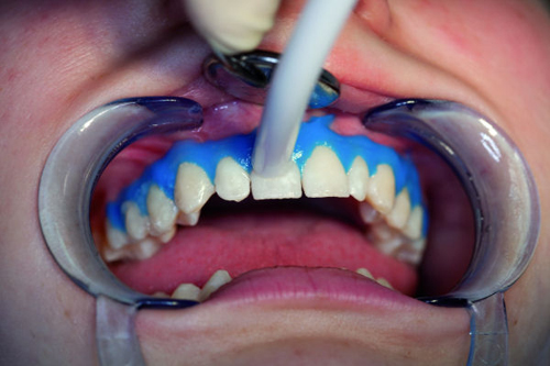 Quy trình và chi phí tẩy trắng răng 3