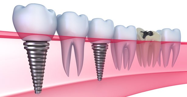 Chi phí cấy ghép răng implant có giá bao nhiêu 