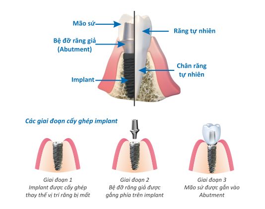 Cấy ghép Implant an toàn và vô trùng tại Sài Gòn