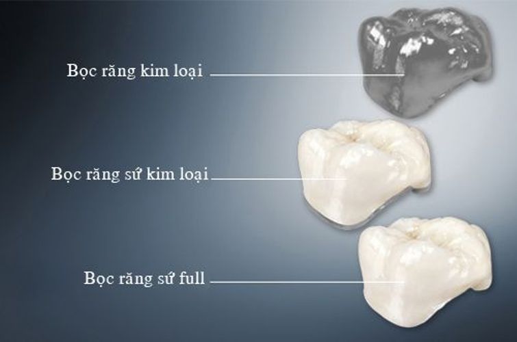 Giá răng sứ thẩm mỹ tùy thuộc vào từng loại răng