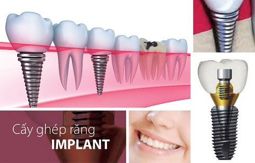 Kỹ thuật trồng răng Implant có khó không 1