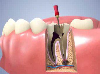 Răng chết tủy cùng với những tai biến khi bọc răng sứ