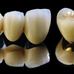 Răng sứ titan có tốt không khi trong cơ thể con người