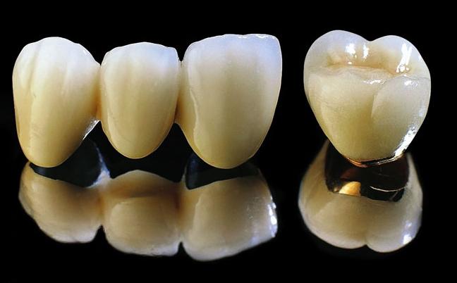 Răng sứ titan có tốt không khi trong cơ thể con người