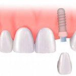 Cấy ghép implant cho một răng