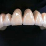 Răng sứ cercon là gì