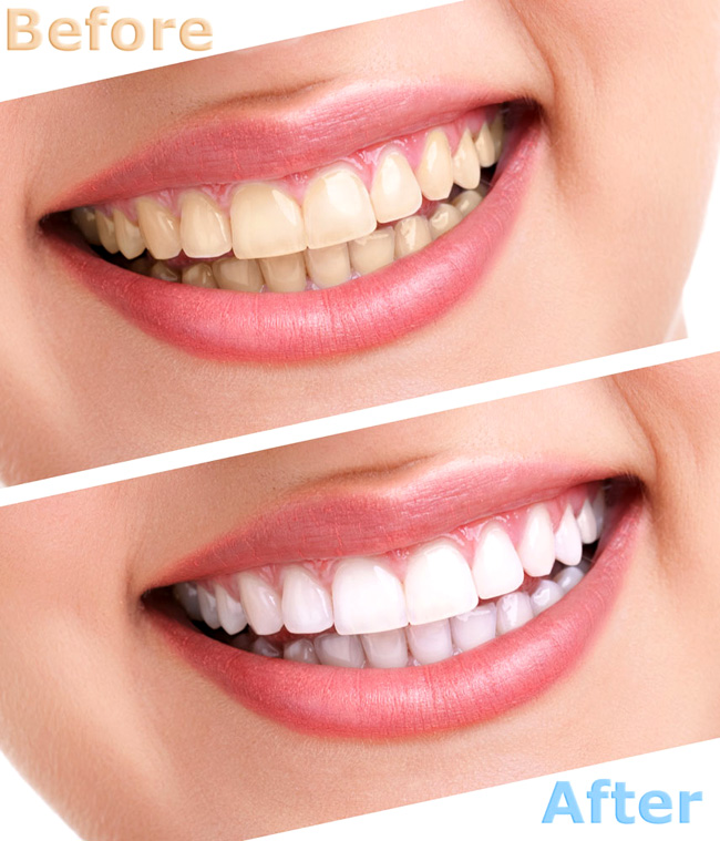Tẩy trắng răng bằng đèn Plasma mang lại hàm răng trắng tự nhiên