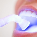Tẩy trắng răng bằng Laser Whitening có an toàn không?