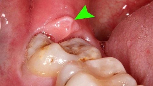 Những điều cần biết về nhổ răng 2