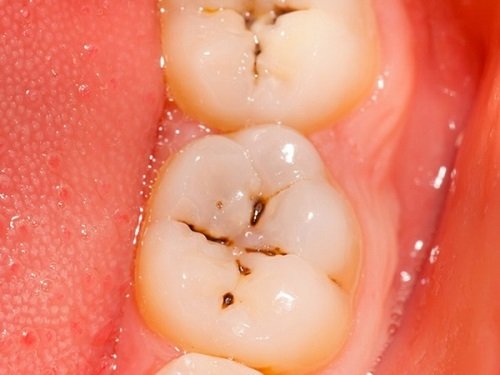 Những lưu ý khi bị sâu răng 1
