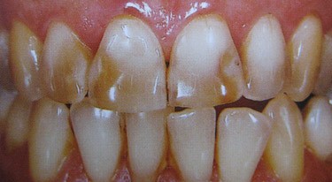 Thế nào là răng nhiễm thuốc kháng sinh Tetracycline 01