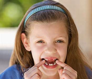 Chế độ chăm sóc cho trẻ sau nhổ răng 