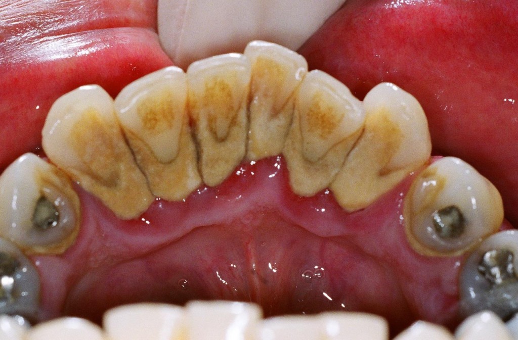 Tại sao phải lấy vôi răng định kỳ ?