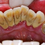 Tại sao phải lấy vôi răng định kỳ?