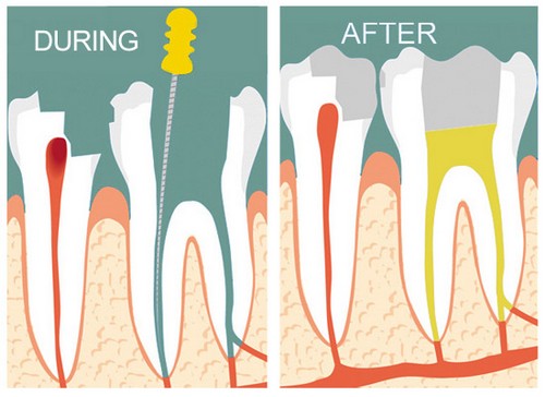 Lấy tủy khi làm răng sứ