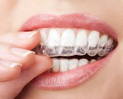 Niềng răng là giải pháp mới cho tình trạng răng mọc chen chúc