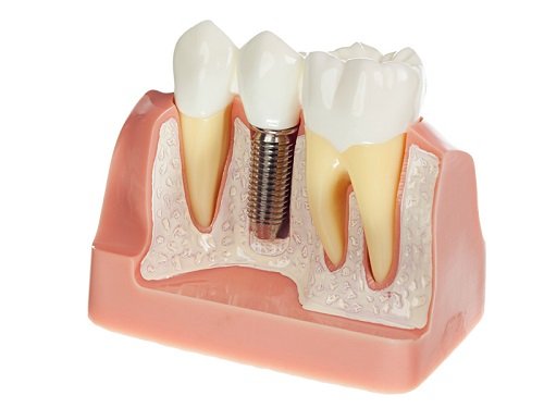 Các phương pháp trồng răng giả hiện nay 3