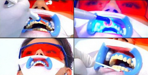 Công nghệ tẩy trắng răng tại nha khoa