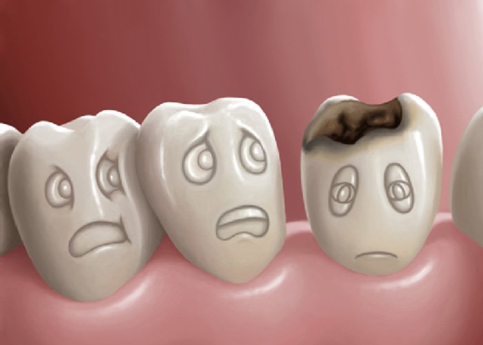 Điều trị sâu răng cho trẻ em 1