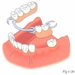 Các phương pháp trồng răng giả hiện nay