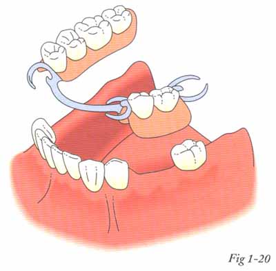 Các phương pháp trồng răng giả
