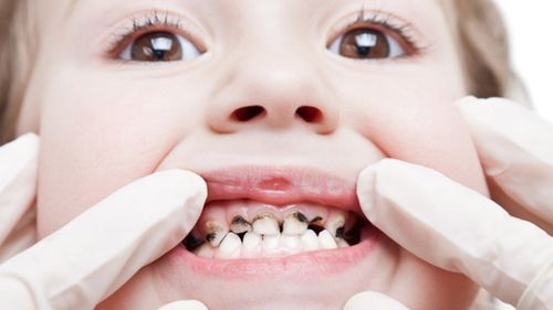 Phòng ngừa sâu răng cho trẻ em 1
