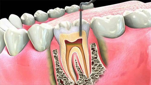 Quy trình lấy tủy răng khi phục hình răng sứ thẩm mỹ 1