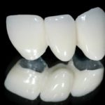 Lựa chọn mới của phục hình răng toàn sứ
