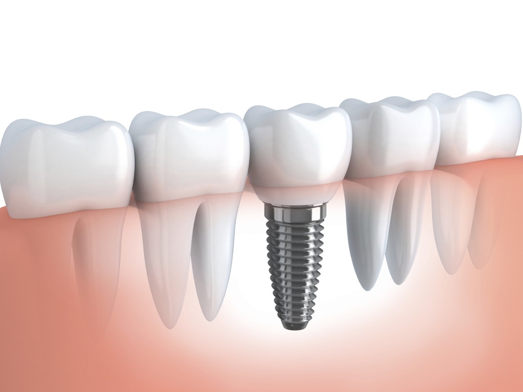 Giá trồng răng Implant tại TP. Hồ Chí Minh là bao nhiêu?