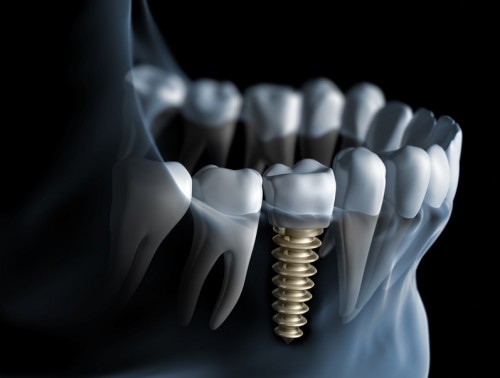 Implant được cấy ghép vào xương hàm