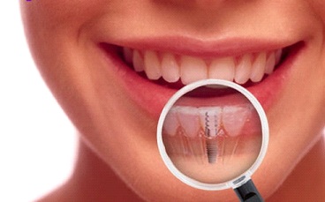 Quy trình cấy ghép Implant khi phục hình răng được thực hiện thế nào?