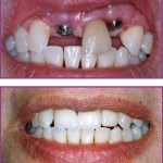 Quy trình cấy ghép Implant khi phục hình răng