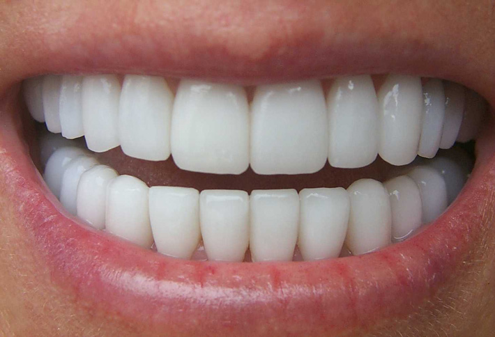 Tẩy trắng răng hiệu quả tại nhà