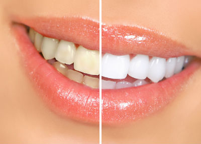 Tẩy trắng răng tại nhà đem lại hiệu quả như ý