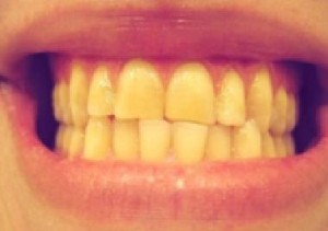 Bốn thói quen xấu gây vàng răng