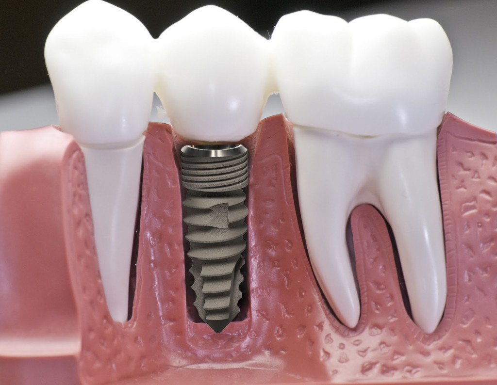 Chi phí cấy ghép răng implant bao nhiêu tiền