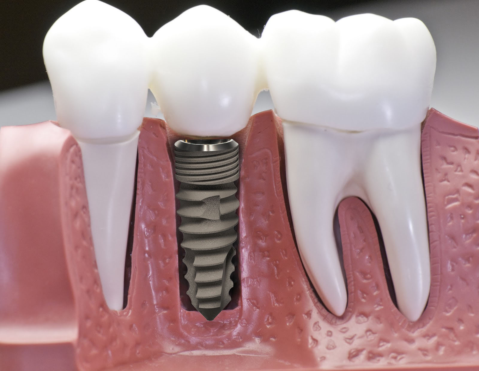 Răng implant trong hàm