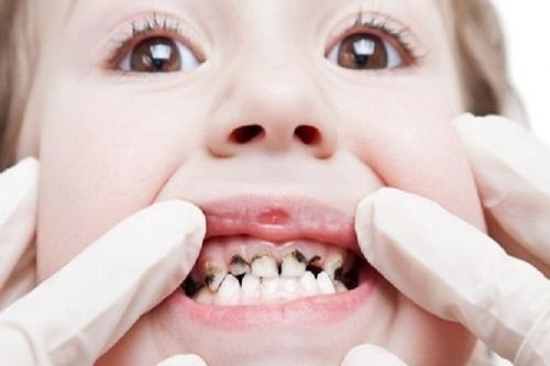 Công nghệ mới điều trị sâu răng 1