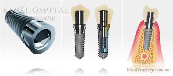 cay-ghep-implant-co-an-toan-khong1.jpg