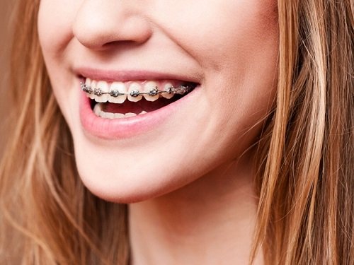 Niềng răng mắc cài kim loại thế hệ mới có ưu điểm gì? 1