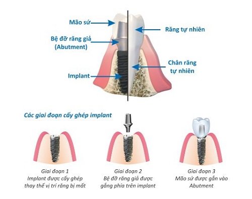 Implant ngăn ngừa tiêu xương hàm 2