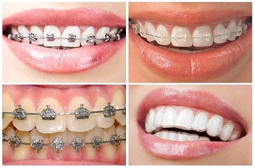 Người trưởng thành nên chọn kỹ thuật niềng răng nào? 2