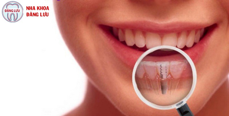 Chi phí trồng răng implant bao nhiêu?