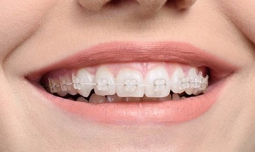 Phương pháp niềng răng mắc cài sứ 1