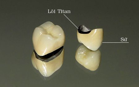 các loại răng sứ