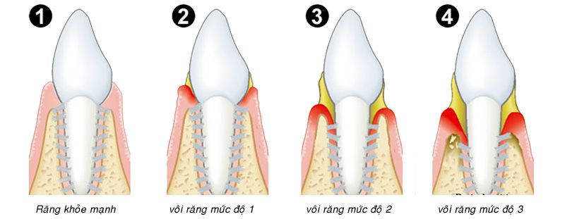 Vôi răng ảnh hưởng lớn đến nướu răng và hàm