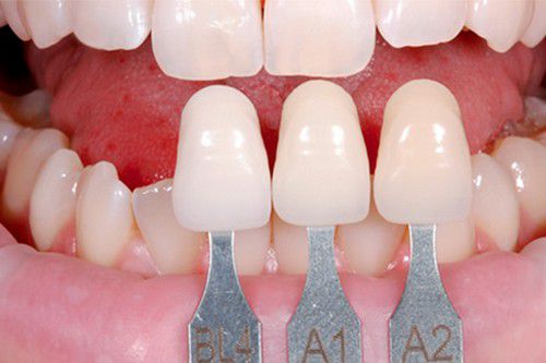 Những cách phục hình răng thẩm mỹ