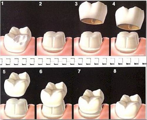 Những cách phục hình răng thẩm mỹ