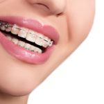 Niềng răng mắc cài sứ phương pháp chỉnh nha hiệu quả